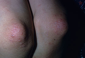 Eczema due to allergic reaction to Fiberglass