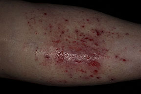 Photo of a leg covered in Eczema