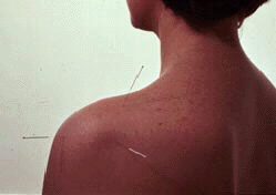 An Acupuncture Treatment Photograph